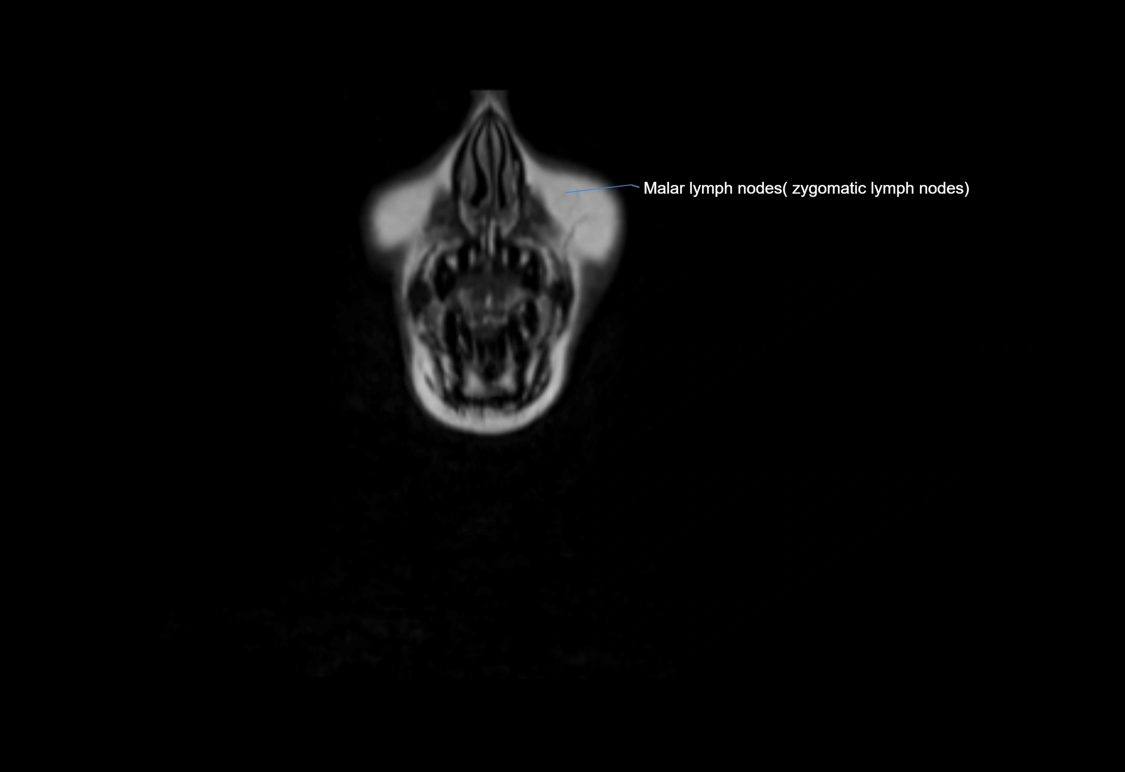 Neck coronal lymph node cross sectional MRI anatomy 3T MRI  image-img-00001-00074.webp